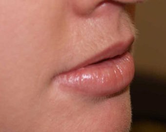 Lips cosmetic treatment - before