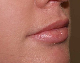 Lips cosmetic treatment - after