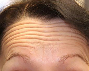 Forehead Lines cosmetic treatment - before