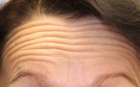 Forehead Lines