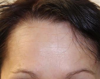 Forehead Lines cosmetic treatment - after