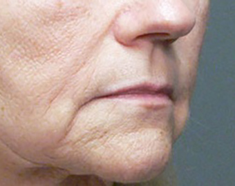 Marionette Lines cosmetic treatment - before