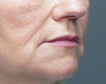 Marionette Lines cosmetic treatment - after