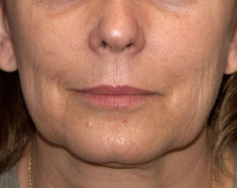 Jowls and Jawline cosmetic treatment - before