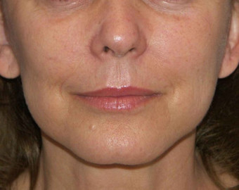 Jowls and Jawline cosmetic treatment - after