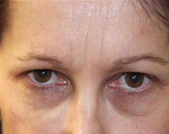 Frown Lines cosmetic treatment - after