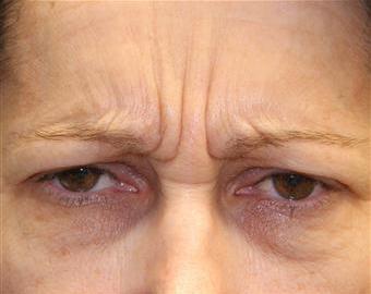 Frown Lines cosmetic treatment - before